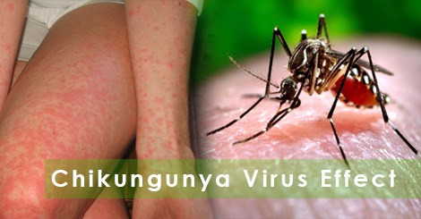 Hàn Quốc phát hiện trường hợp nghi nhiễm sốt Chikungunya ảnh 1
