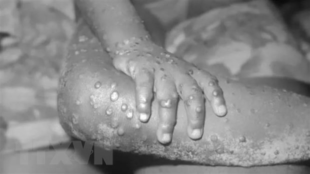 Ảnh minh họa. (Nguồn: Getty Images) Canada và Israel ghi nhận thêm nhiều ca mắc bệnh đậu mùa khỉ ảnh 1