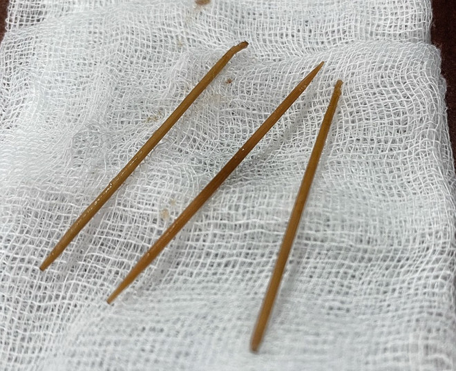 Sóc Trăng: Một người nhập viện cấp cứu vì nuốt tăm trong khi ngủ ảnh 1