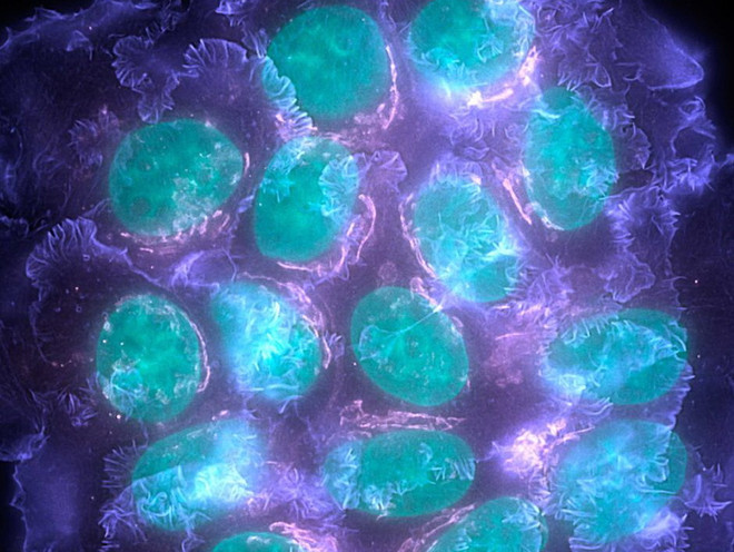 (Nguồn: abc.net.au) Xác định được các gene đột biến có khả năng gây bệnh ung thư vú ảnh 1