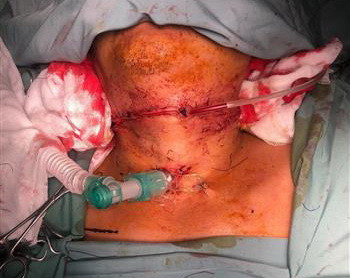 Cần Thơ: Cứu sống bệnh nhân bị đứt rời khí quản, thực quản ảnh 1