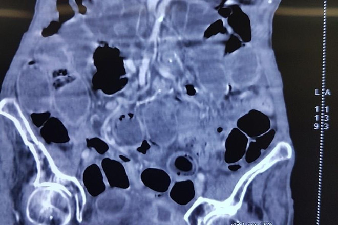 Cứu sống một cụ bà 90 tuổi bị thủng ruột do bệnh lý hiếm gặp ảnh 1