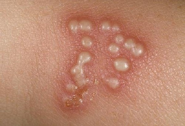 Ảnh minh họa (Nguồn: AP) Nghiên cứu nguồn gốc căn bệnh viêm da phổ biến do nhiễm virus herpes ảnh 1