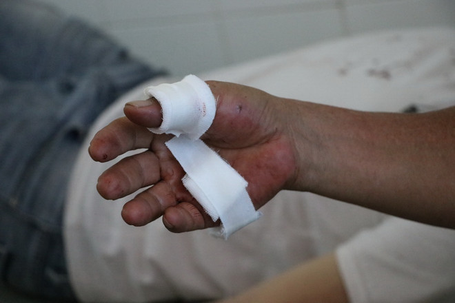 Hai cha con bất ngờ bị đạn chì bắn trúng tay ngay tại sân nhà ảnh 1