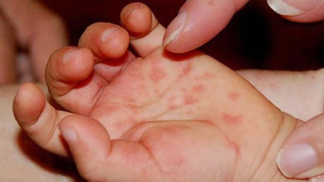 Trẻ bị tay chân miệng không cần cách ly, vẫn nên cho đi học với các bạn. Đúng hay sai?