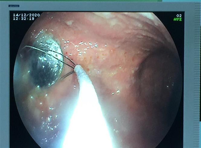 Cấp cứu kịp thời bé gái 4 tuổi nuốt phải đồng xu trong lúc chơi đùa ảnh 1