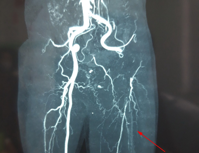 Cảnh báo nguy cơ tắc động mạch chi cấp tính khi bị tê bì chân tay ảnh 1