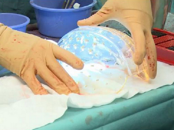 Hà Lan: Cấy ghép thành công hộp sọ 3D cho một phụ nữ ảnh 1