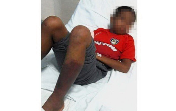 Bị người giám sát tra tấn, một học sinh Malaysia phải cắt bỏ hai chân ảnh 1