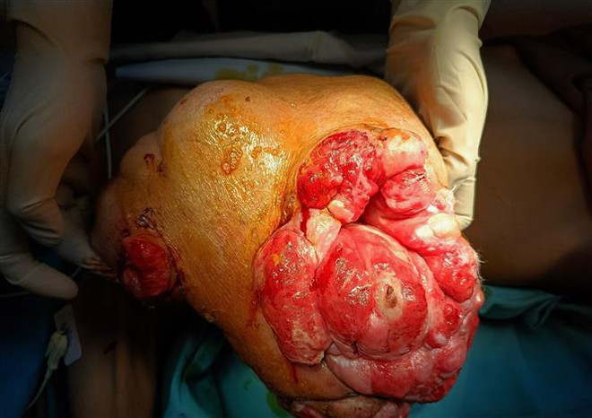 Phẫu thuật thành công khối u vú gần 5kg cho một nữ bệnh nhân ảnh 1