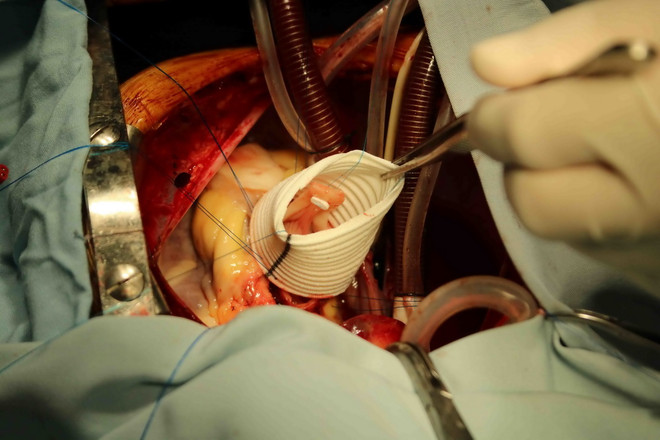 Cấp cứu kịp thời bé trai 12 tuổi bị vỡ phình động mạch chủ ảnh 1