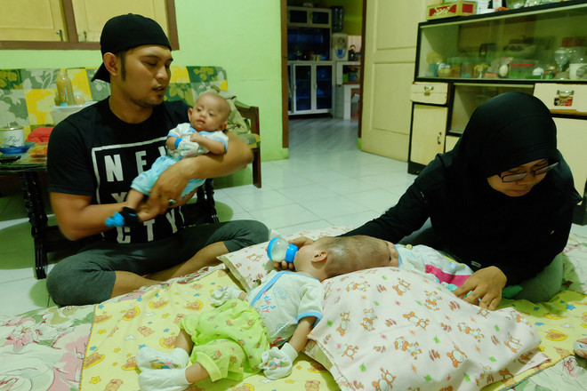 Cận cảnh hai bé gái 4 tháng tuổi bị dính liền đầu thương tâm ảnh 2