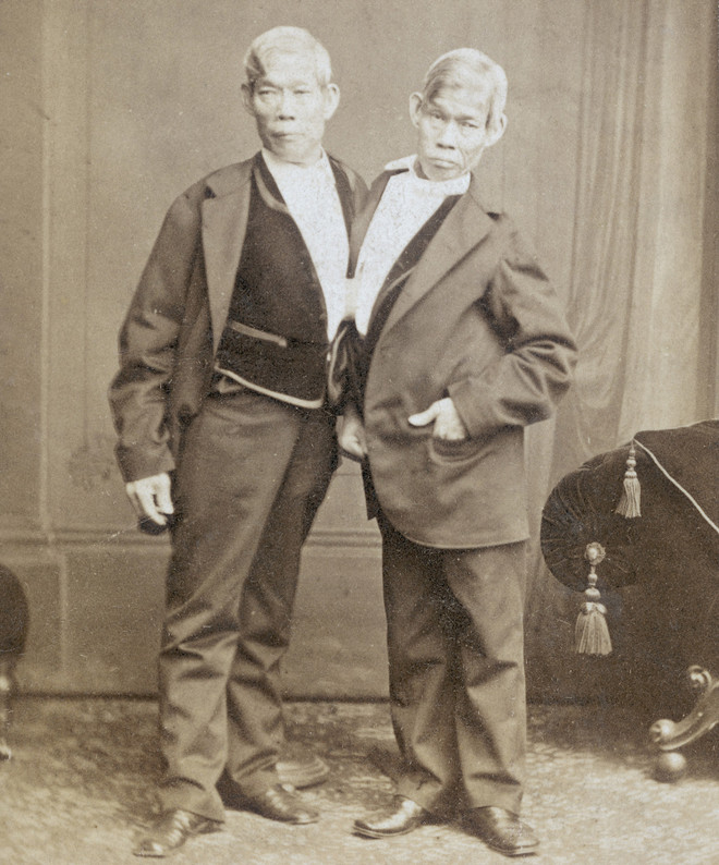 Cận cảnh hai bé gái 4 tháng tuổi bị dính liền đầu thương tâm ảnh 4