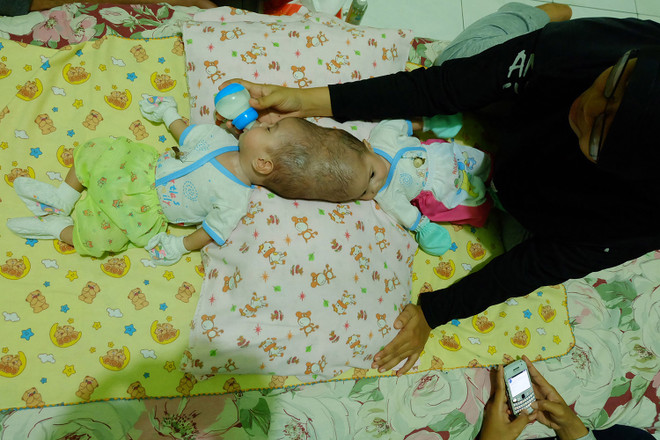 Cận cảnh hai bé gái 4 tháng tuổi bị dính liền đầu thương tâm ảnh 3