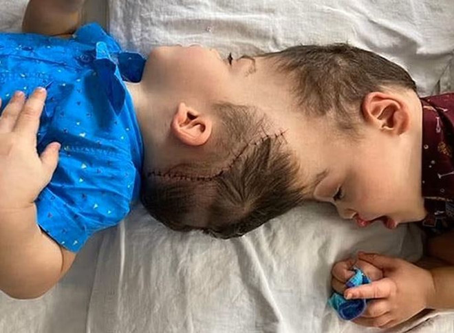 Dùng công nghệ thực tế ảo phẫu thuật tách rời cặp song sinh dính đầu ảnh 1