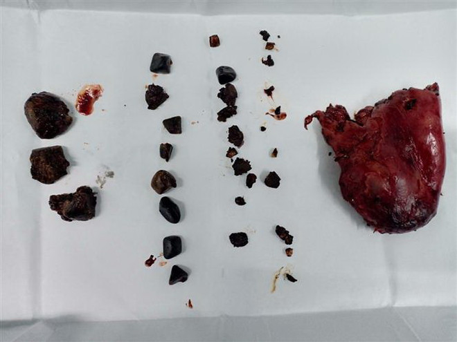 Phát hiện gần 50 viên sỏi ở túi mật của một bệnh nhân Trung Quốc ảnh 2