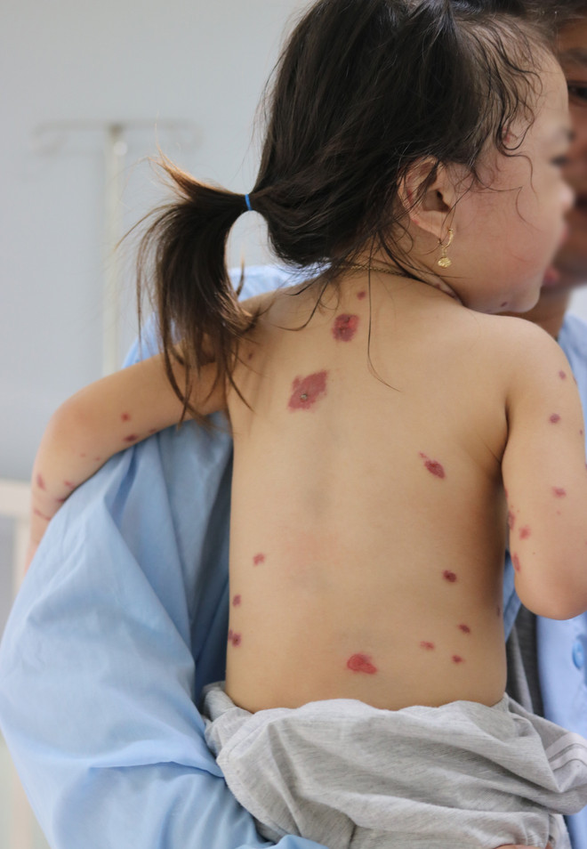 Nguy cơ mắc viêm da dị ứng cấp tính ở trẻ nhỏ do dùng thuốc tùy tiện ảnh 1