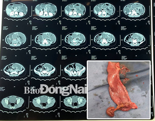 Phẫu thuật thành công cho một bệnh nhi bị lồng ruột non hiếm gặp ảnh 1