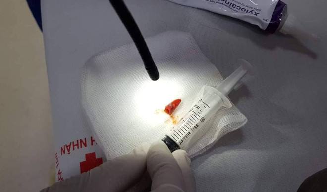 Hy hữu mảnh ớt dài 12mm rơi vào phế quản gây tổn thương phổi ảnh 1