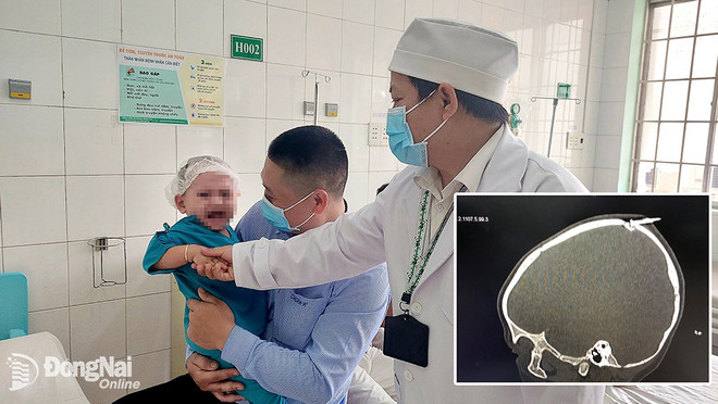 Đồng Nai: Cứu sống bé trai 2 tuổi bị đinh đâm qua xương sọ ảnh 1