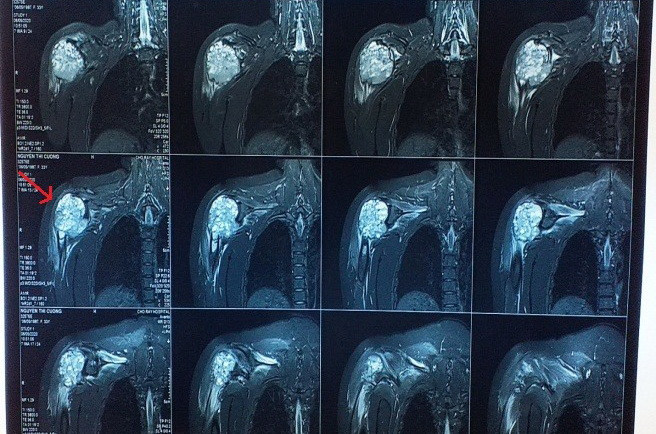 Cần Thơ: Một bệnh nhân suýt mất cánh tay vì 'thầy lang vườn' ảnh 1