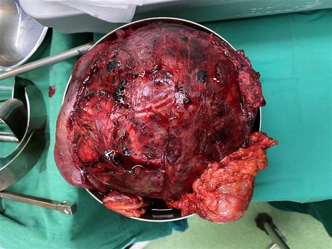 Bệnh viện Chợ Rẫy bóc tách khối u tuyến tụy lớn nhất từ trước đến nay ảnh 1