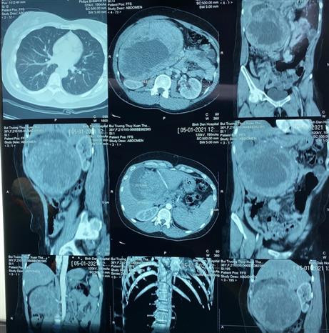 Bệnh viện Chợ Rẫy bóc tách khối u tuyến tụy lớn nhất từ trước đến nay ảnh 2