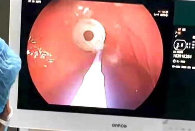 Quảng Bình: Lấy thành công bulông xe máy ra khỏi dạ dày bé trai 5 tuổi ảnh 1