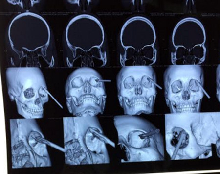 Yên Bái: Một thiếu nữ bị đoạn sắt đâm xuyên mắt phải, thủng nhãn cầu ảnh 1