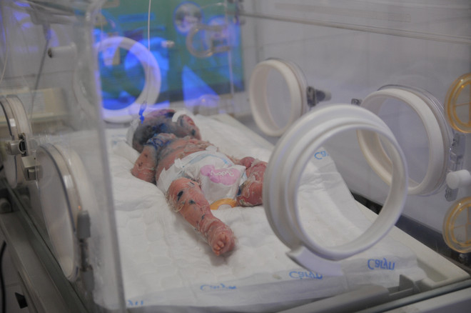 Điều trị cho bé trai 2 tháng tuổi mắc bệnh da vảy cá hiếm gặp ảnh 1