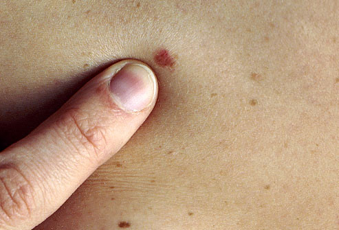 Ảnh minh họa. (Nguồn: WebMD) Australia phát triển phương pháp chẩn đoán nhanh ung thư da ảnh 1