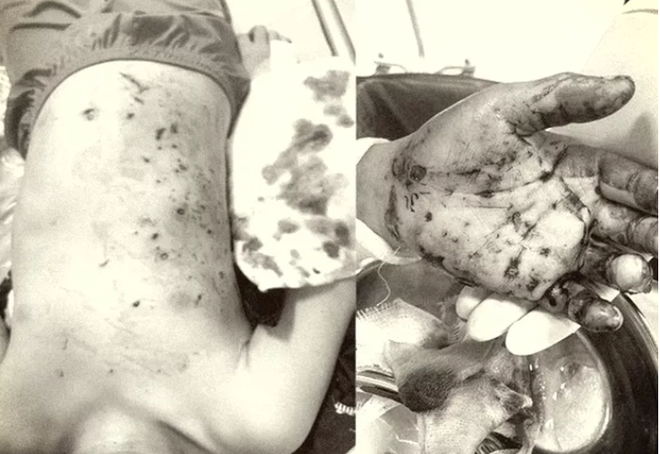 Quảng Ninh: Nổ pin điều khiển đồ chơi, bé trai bị đa chấn thương ảnh 1