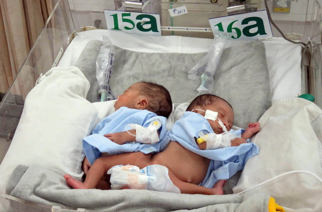 Tách thành công cặp song sinh dính nhau hậu môn và tủy sống ảnh 1