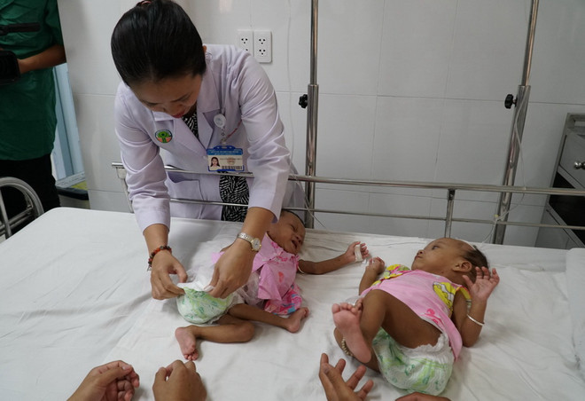 Tách thành công cặp song sinh dính nhau hậu môn và tủy sống ảnh 2