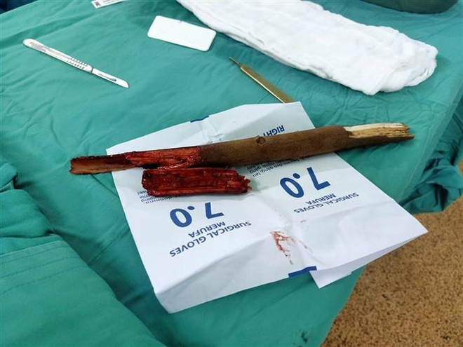 Bà Rịa-Vũng Tàu: Cấp cứu thành công bệnh nhân bị cành cây đâm vào cổ ảnh 1