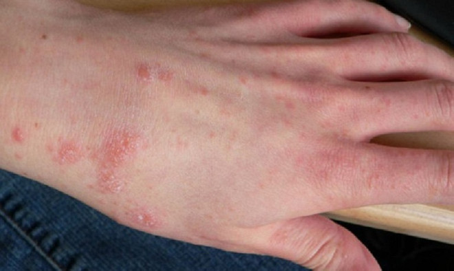 Quảng Ngãi: Bệnh ghẻ lây lan trong thôn có đông đồng bào dân tộc Cor ảnh 1