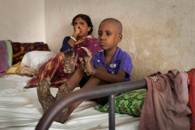 Mắc bệnh lạ, tay chân cậu bé đáng thương xù xì như vỏ cây ảnh 4