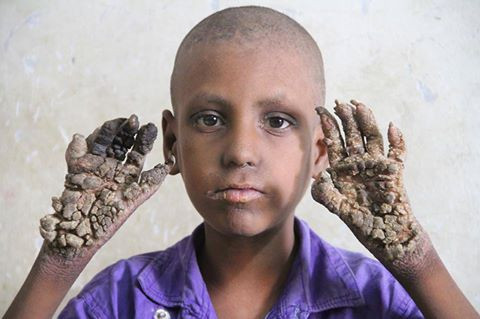 Mắc bệnh lạ, tay chân cậu bé đáng thương xù xì như vỏ cây ảnh 1