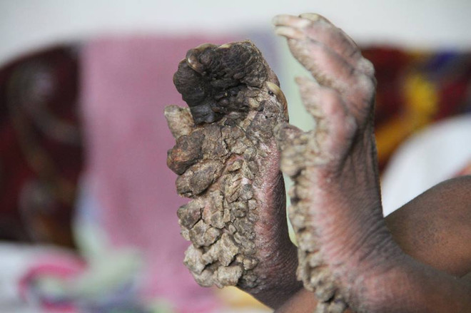 Mắc bệnh lạ, tay chân cậu bé đáng thương xù xì như vỏ cây ảnh 3