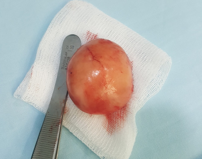 Phẫu thuật thành công cho bệnh nhân có 3 tinh hoàn hiếm gặp ảnh 2