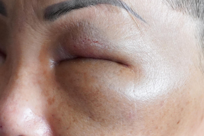 Tây Ninh: Tiêm filler trong nhà nghỉ, hai phụ nữ bị tai biến ảnh 1