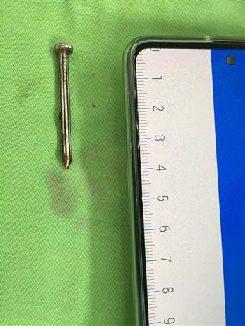 Cần Thơ: Cứu sống bệnh nhân trầm cảm tự đóng đinh lên đầu ảnh 2