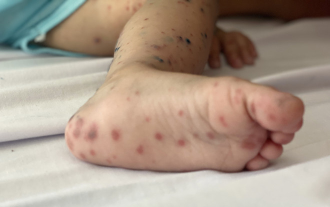 Nốt hồng ban ở chân của một trẻ mắc bệnh tay chân miệng. (Ảnh: Đinh Hằng/TTXVN) Vaccine phòng tay chân miệng đầu tiên ở Việt Nam có hiệu quả 96,8% ảnh 1