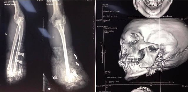 Nam thanh niên bị cụt hai tay, gãy xương hàm vì tự chế pháo nổ ảnh 1