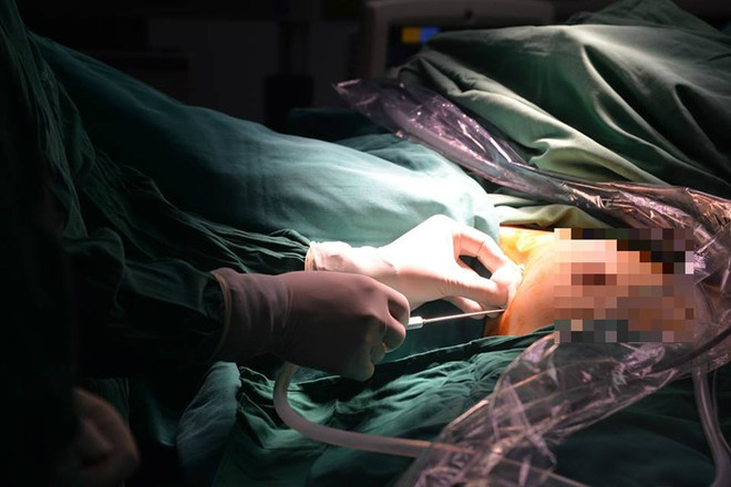 Việt Nam là nước đầu tiên trên thế giới mổ nội soi tuyến giáp một lỗ ảnh 1