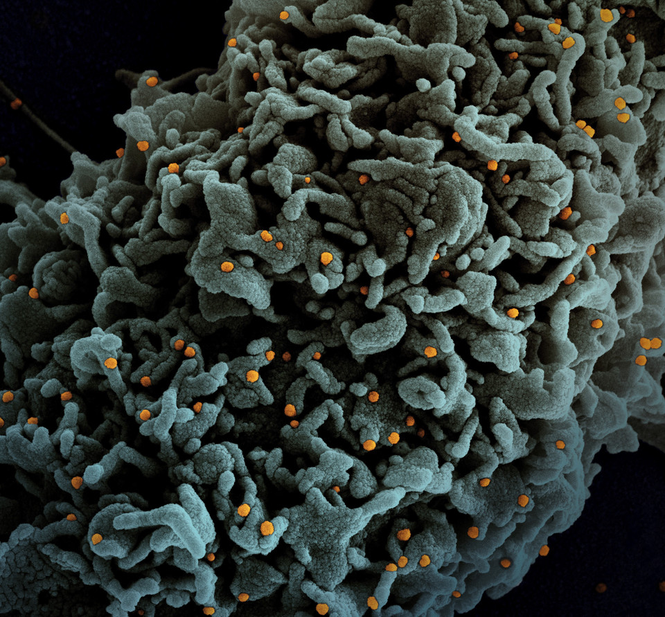 Hình ảnh từ kính hiển vi do Viện nghiên cứu bệnh truyền nhiễm và dị ứng quốc gia Mỹ cung cấp cho thấy một tế bào (màu xanh) của bệnh nhân COVID-19 bị nhiễm virus SARS-CoV-2 (màu vàng). (Ảnh: AFP/TTXVN)