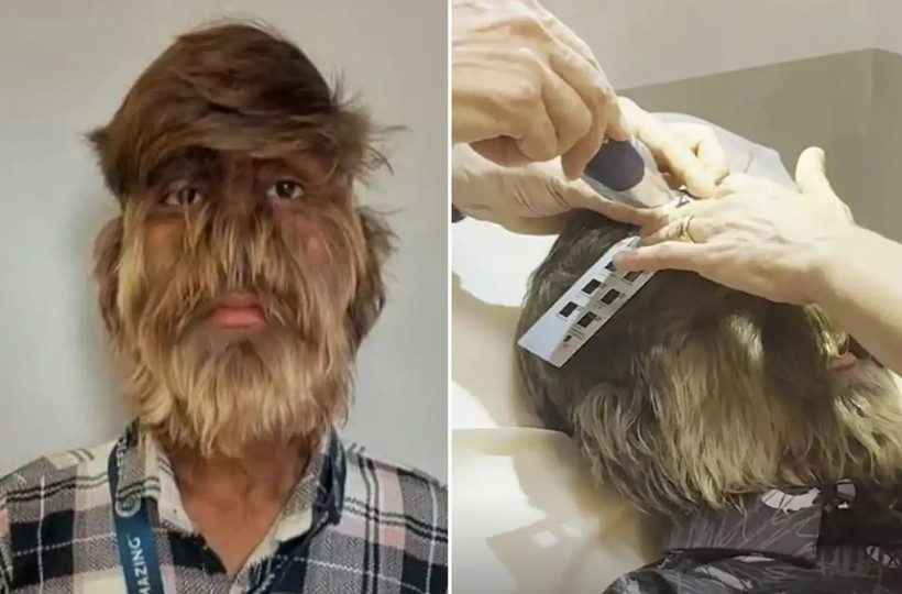 Lalit Patidar mắc phải hội chứng bệnh hiếm gặp có tên gọi là “chứng rậm lông”. (Nguồn: The Sun)