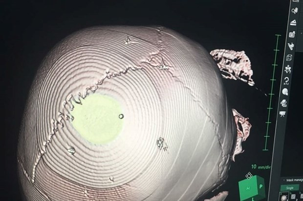 Đề nghị xác minh và xử lý nghiêm vụ bé gái nghi bị đinh găm vào đầu ảnh 1