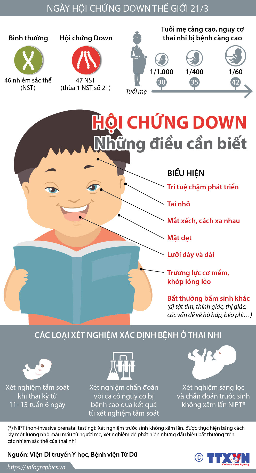[Infographics] Những điều cần biết về hội chứng Down ở trẻ ảnh 1