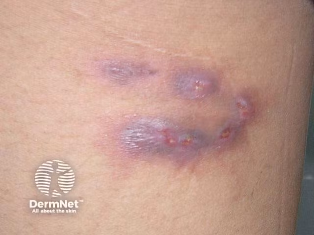 Thái Lan ban hành cảnh báo khẩn cấp về bệnh “sốt đất”